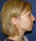 Rhinoplasty (Nose Job) - Photo before - Klinika Laser Esthetic