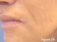 Mesotherapy (face, neck revitalization) - Photo before - Klinika Laser Esthetic
