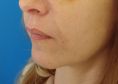 Lipofilling, Lipografting, Lipotransfer (přenos a aplikace vlastního tuku) - fotka před - MUDr. Evžen Trupar Ph.D.