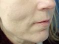 Lipofilling, Lipografting, Lipotransfer (přenos a aplikace vlastního tuku) - fotka před - MUDr. Evžen Trupar Ph.D.