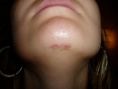 Scar removal - Photo before - Klinika Laser Esthetic
