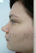 Septoplasty - Photo before - Dr. med. Jozefina Skulavik