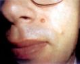 Laser skin tag removal - Photo before - Klinika Laser Esthetic