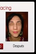 Rejuvenecimiento facial con láser fraccionado - Foto Antes de - Dr. Aristides Arellano-Huacuja