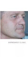 Spider veins laser removal (redness, birh marks) - Photo before - Bieńkowscy Clinic®