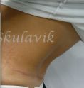 Abdominoplasty (Tummy Tucks) - Photo before - Dr. med. Jozefina Skulavik