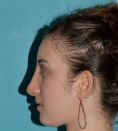 Rhinoplastie - Bosse volumineuse du nez sur visage globalement convexe. Profiloplastie avec réduction nasale par voie ouverte, harmonisation du profil par Genioplastie (transposition osseuse )