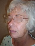 Facelift - Photo before - Matthew M. Akers, MD