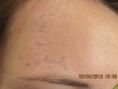 Scar removal - Photo before - Klinika Laser Esthetic