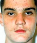 Laser acne treatment - Photo before - Klinika Laser Esthetic