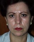 Fotorejuvenecimiento (IPL) - rejuvenecimiento de la piel - Foto Antes de - Dr. Aristides Arellano-Huacuja