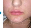 Lip augmentation - cheiloplasty - Photo before - Dr. med. Dagmar Arco
