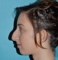 Rhinoplastie - Bosse volumineuse du nez sur visage globalement convexe. Profiloplastie avec réduction nasale par voie ouverte, harmonisation du profil par Genioplastie (transposition osseuse )