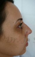 Septoplasty - Photo before - Dr. med. Jozefina Skulavik