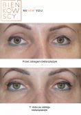 Eyelid surgery (Blepharoplasty) - Photo before - Dr n. med. Marcin Bieńkowski