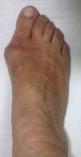 Cirugía de juanetes (hallux valgus) - Foto Antes de - Doctor Juan Carlos Albornoz