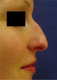 Rhinoplasty (Nose Job) - Photo before - Klinika Laser Esthetic