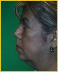 Fotorejuvenecimiento (IPL) - rejuvenecimiento de la piel - Foto Antes de - Dr. Aristides Arellano-Huacuja