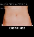 CoolSculpting - Photo before - Dr. Rodrigo Morales De la Cerda
