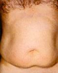 Liposuction - Photo before - Klinika Laser Esthetic