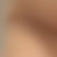 Breast Augmentation - Breast Implants - Age: 20 – 25 year old female. Photos taken 3 months post operation