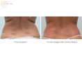 Ultrasonic cavitation - Photo before - Bieńkowscy Clinic®