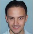 Haartransplantation - Vorher Foto - Prohaarklinik