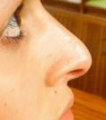 Cirugía de la nariz (Rinoplastia) - Foto Antes de - Dr. Alfonso Quetglas Marimón
