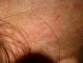 Traitements laser - dermatologie esthétique - Cliché avant - Dr Pierre-Alain Mayeux