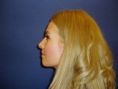 Rhinoplasty (Nose Job) - Photo before - Klinika Laser Esthetic