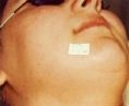 Laser hair removal - Photo before - Klinika Laser Esthetic