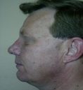 Fotorejuvenecimiento (IPL) - rejuvenecimiento de la piel - Foto Antes de - Dr. Aristides Arellano-Huacuja