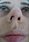 Septoplasty - Photo before - Dr. med. Jozefina Skulavik