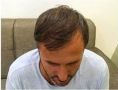 Haartransplantation - Vorher Foto - Prohaarklinik