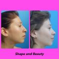 Reducción de mamas - rinoplastia mas rinoxifosis rinoplastia cerrada mujer de 25 años de edad punta caida, colocacion de poste intercrural