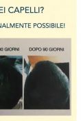 Trapianto capelli - Foto del prima - Dott. Salvatore Scandura M.D.