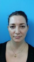 Liposucción - Paciente femenina de 43 años de edad en su tercer mes posoperatorio de eliminacion de bolsas de bichat, se puede observar como el rostro toma forma mas juvenil y triangular