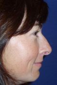 Rhinoplasty (Nose Job) - Photo before - Klinika Laser Esthetic