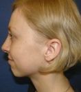 Rhinoplasty (Nose Job) - Photo before - Klinika Laser Esthetic