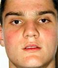 Laser acne treatment - Photo before - Klinika Laser Esthetic