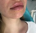 Injekčné výplne - Fotka pred - ENVY klinika estetickej medicíny