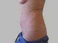 Liposukce - fotka před - OB Care
