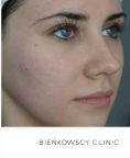 Fractional Laser Resurfacing - Photo before - Bieńkowscy Clinic®