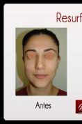 Rejuvenecimiento facial con láser fraccionado - Foto Antes de - Dr. Aristides Arellano-Huacuja
