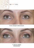 Eyelid surgery (Blepharoplasty) - Photo before - Bieńkowscy Clinic®