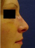 Rhinoplasty (Nose Job) - Photo before - Klinika Laser Esthetic