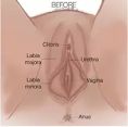 Labiaplasty (Labia Reduction) - Did you know that many women live with pain or reduced sexual pleasure and embarrassment due to a loosening of their vagina or an enlarged or misshapen labia, most often due to aging or childbirth.
While a growing number of women are motivated to improve their sex lives and feel better about themselves, many don’t know where to turn or may feel too embarrassed to discuss this issue with friends, family or even a health care provider. Our physicians want you to know that your health and well-being is their top priority. They have the experience, sensitivity and knowledge to help you.