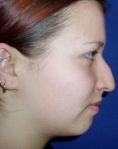 Rhinoplasty (Nose Job) - Photo before - Klinika Laser Esthetic