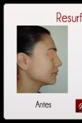 Rejuvenecimiento facial con láser fraccionado - Foto Antes de - Dr. Aristides Arellano-Huacuja