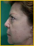 Fotorejuvenecimiento (IPL) - rejuvenecimiento de la piel - Foto Antes de - Dr. Aristides Arellano-Huacuja